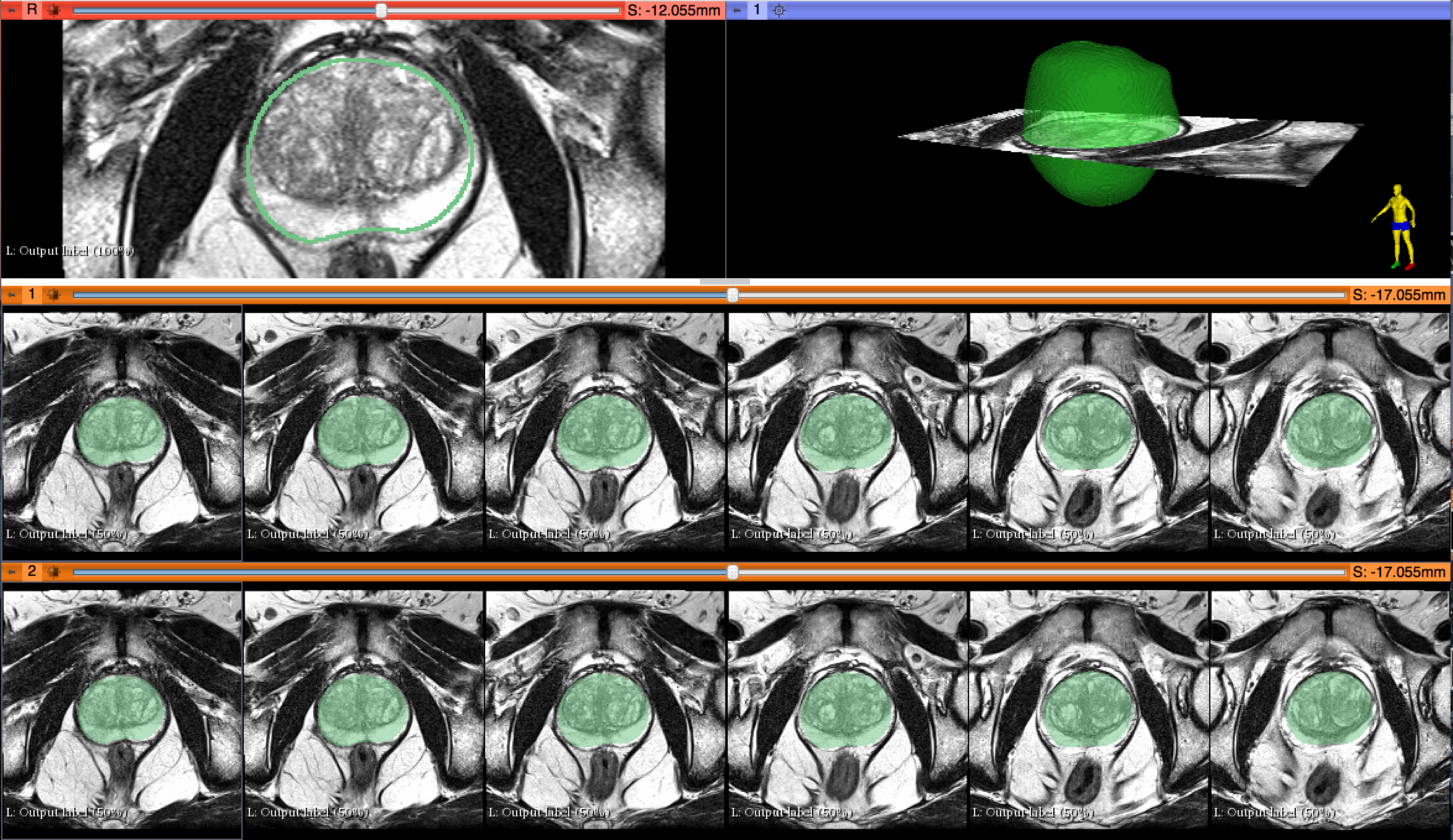 Prostate Volumetirc Measurements in MRI with DeepInfer and 3D Slicer